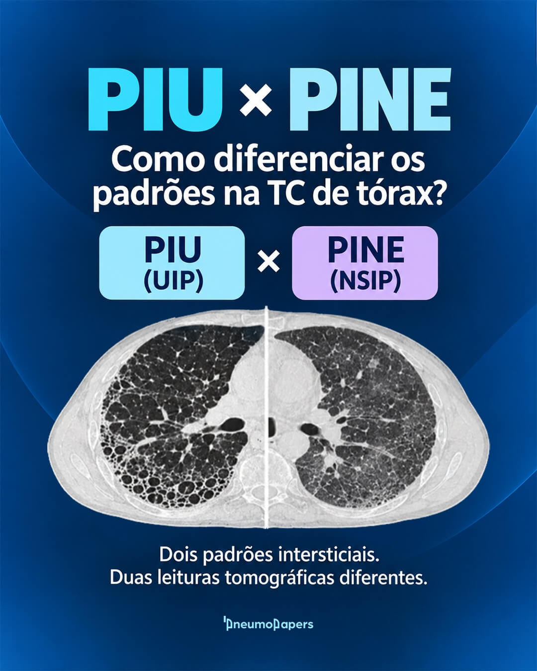 Como diferenciar os padrões na TC de tórax?